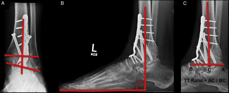 ankle fusion dallas