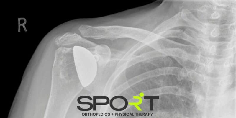 shoulder replacement surgery dallas