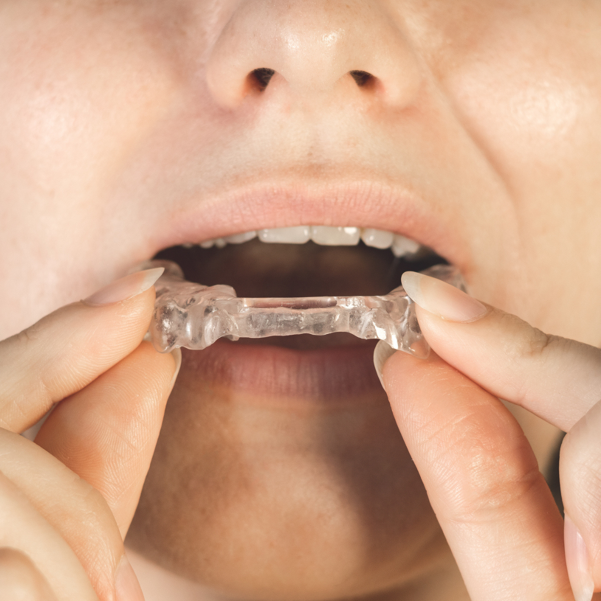 TMJ Splint vs Night Guard: Key Differences Explained