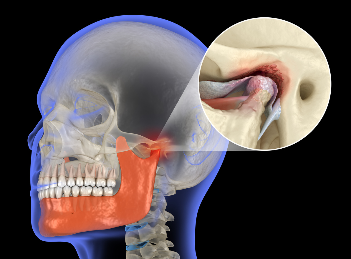 TMJ Dislocation: What It Is, What Causes It, and What to Do