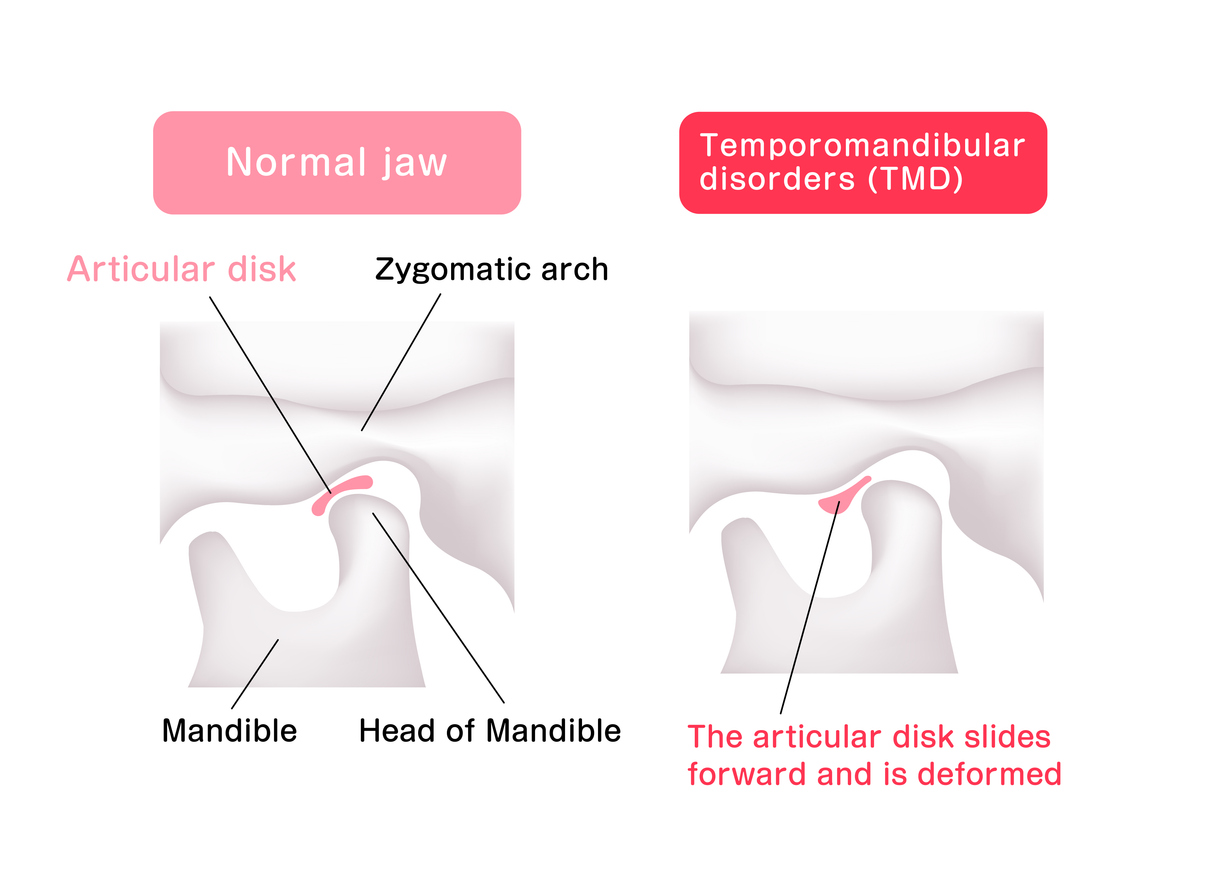 TMJ Disorder vs. Lockjaw: How to Tell the Difference