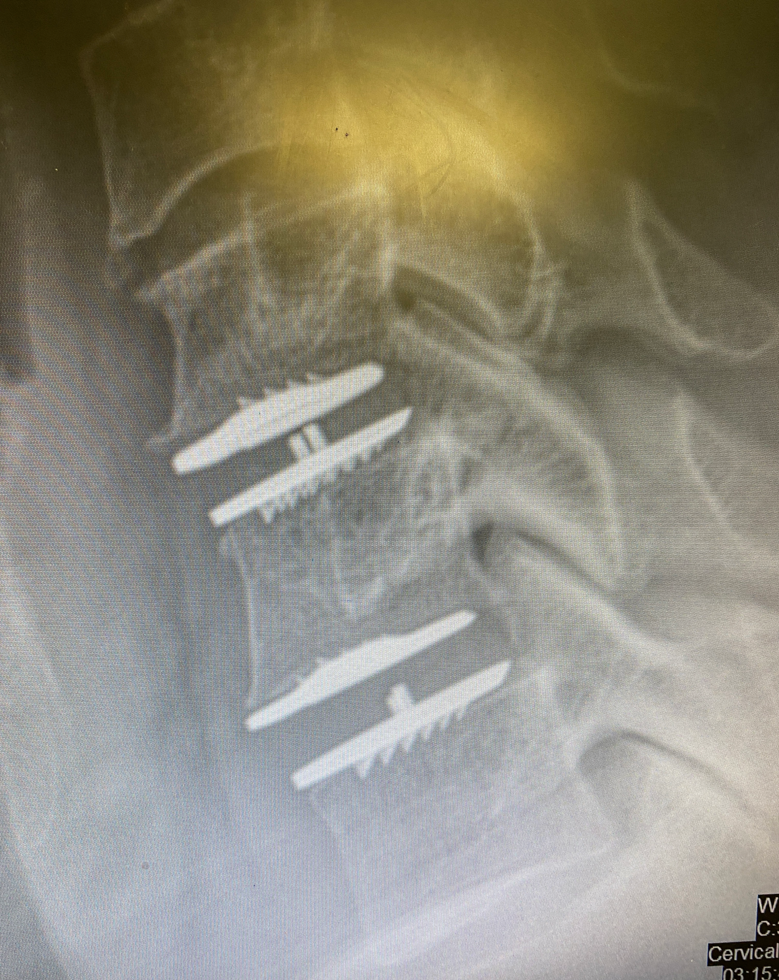 Side MRI of Dr. Riemann's neck showing cervical spine hardware