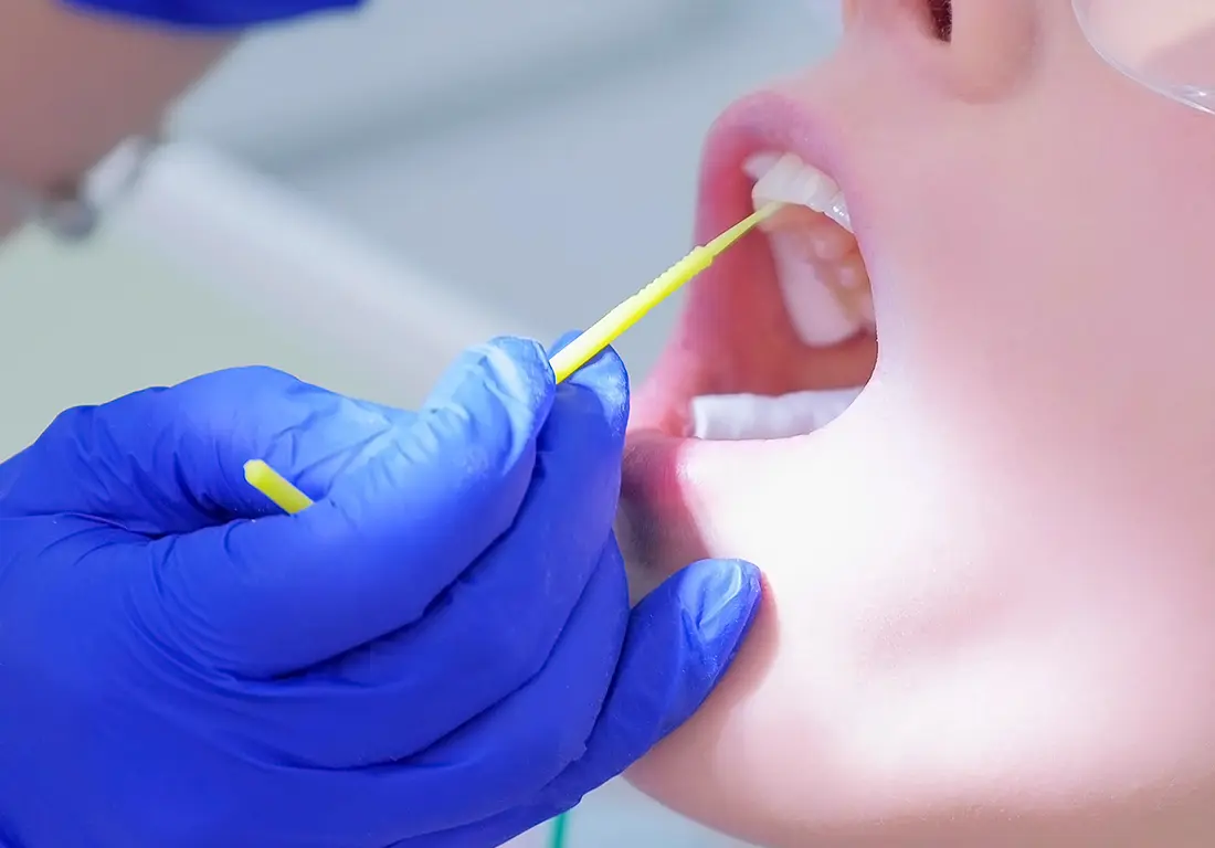 Fluoride Treatments & Alternative Options