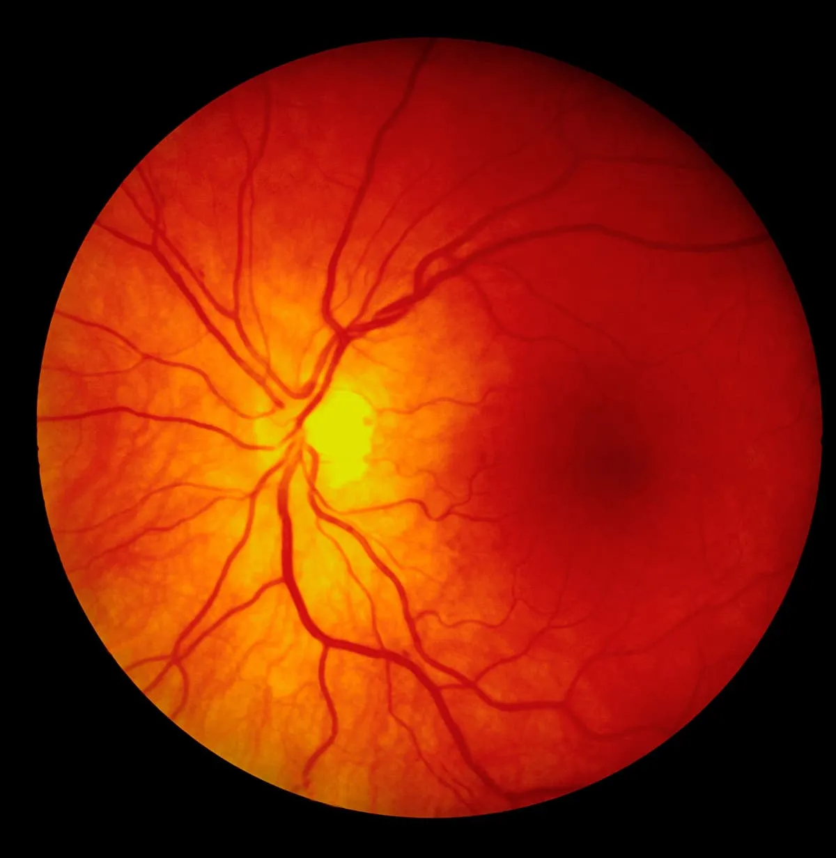 Close-up view of a human retina showing the optic disc and branching blood vessels.
