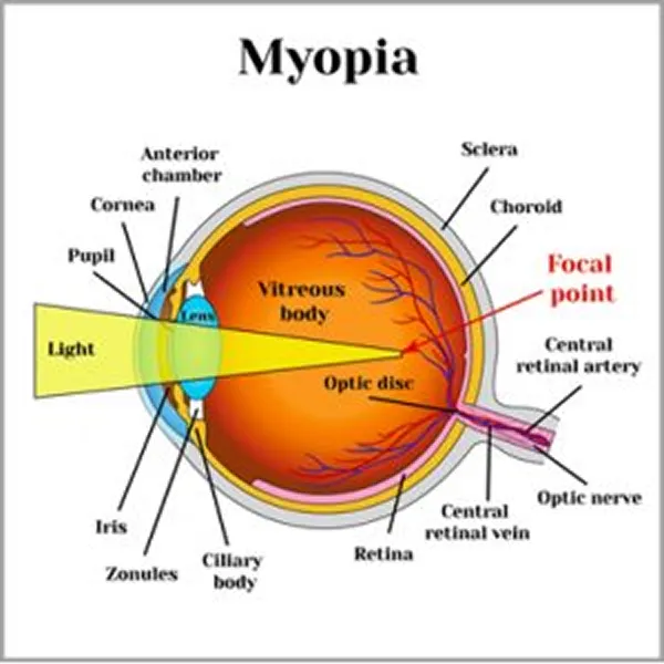 Medical diagram showing myopia (shortsightedness), illustrating how light focuses in front of the retina instead of on it.