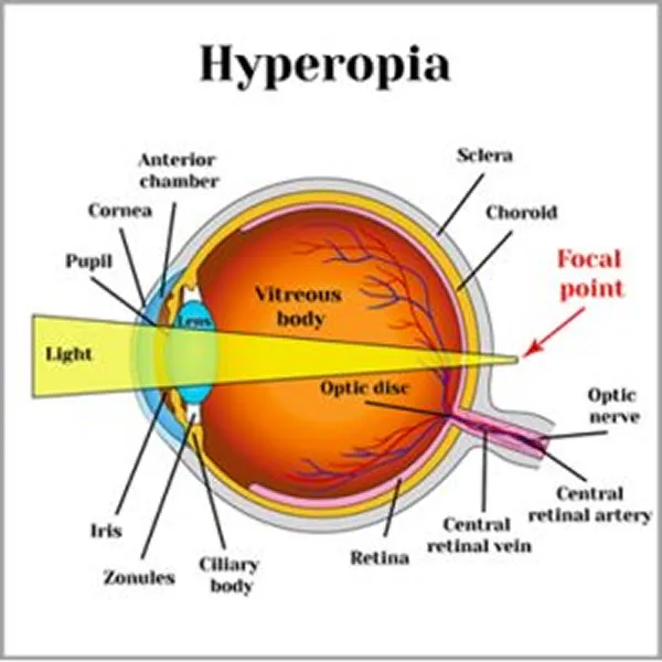 Medical diagram showing hyperopia (farsightedness), illustrating how light focuses behind the retina instead of on it.