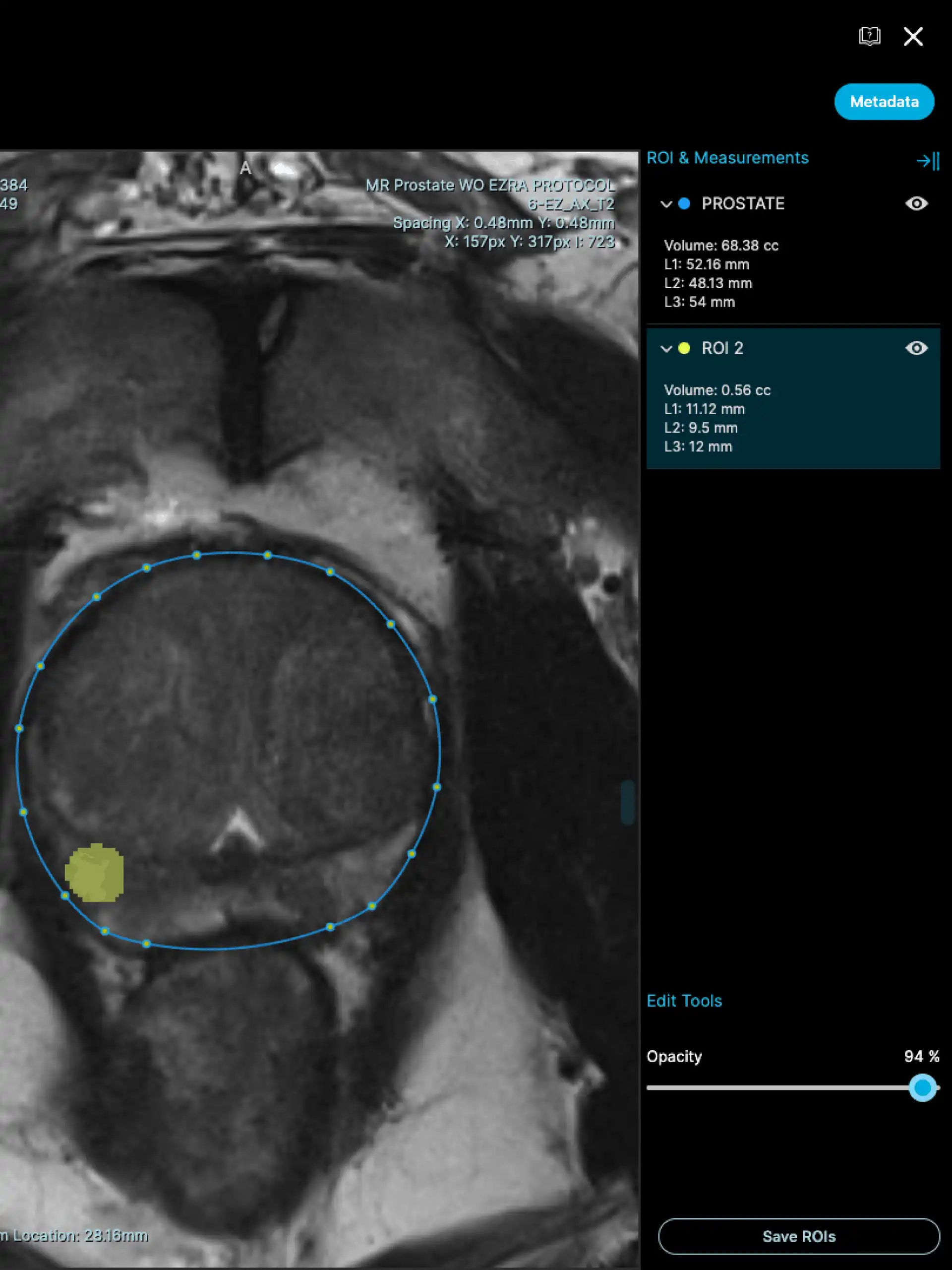 AI Enhanced Image Prostate