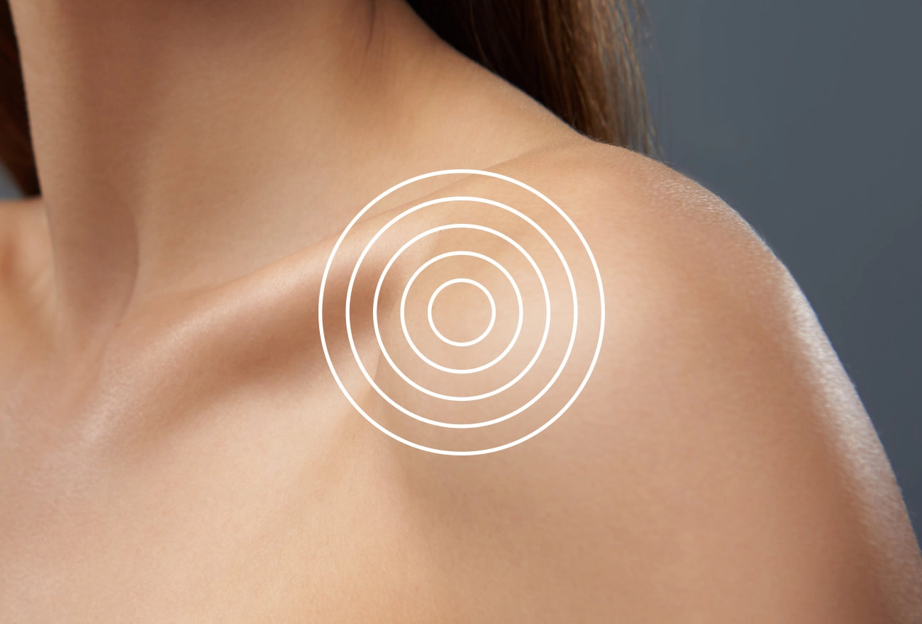 Woman's back and shoulder with white concentric circles indicating pain or targeted treatment area