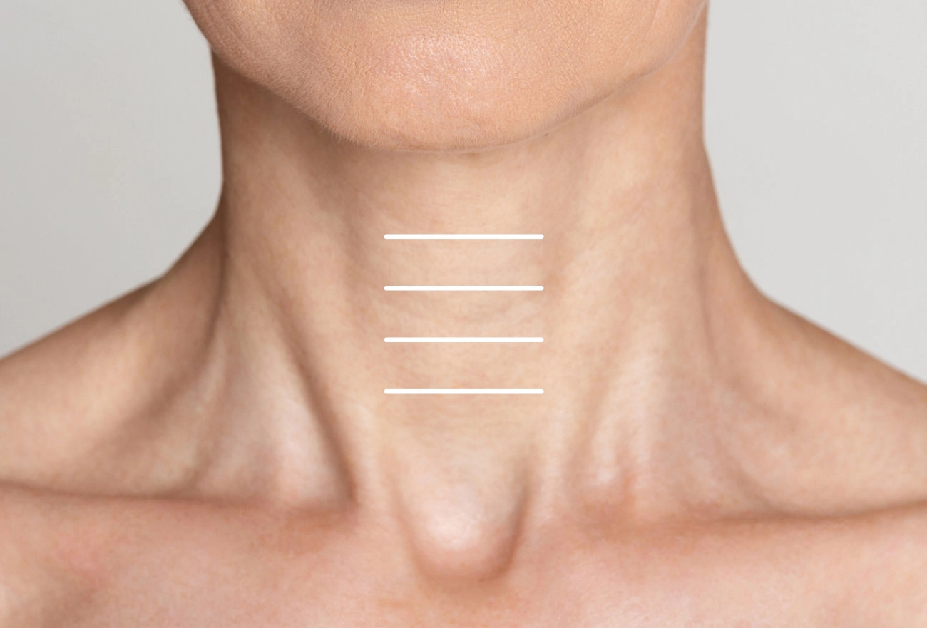 Man's neck with white lines marking thyroid gland location
