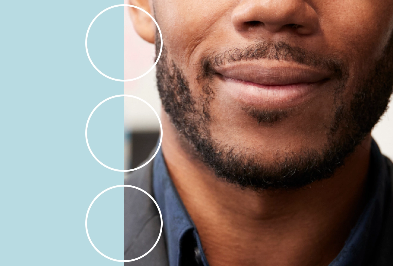 Man with beard shown with circular callouts comparing skin texture and treatment results
