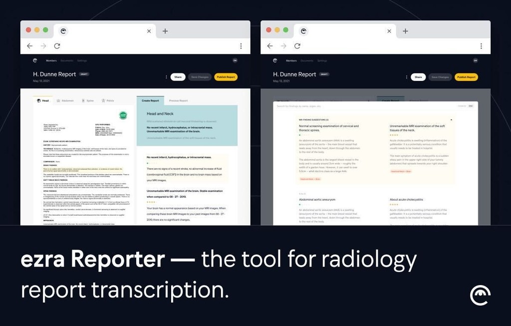 Two browser windows showing ezra Reporter interface for radiology report transcription with H. Dunne Report findings
