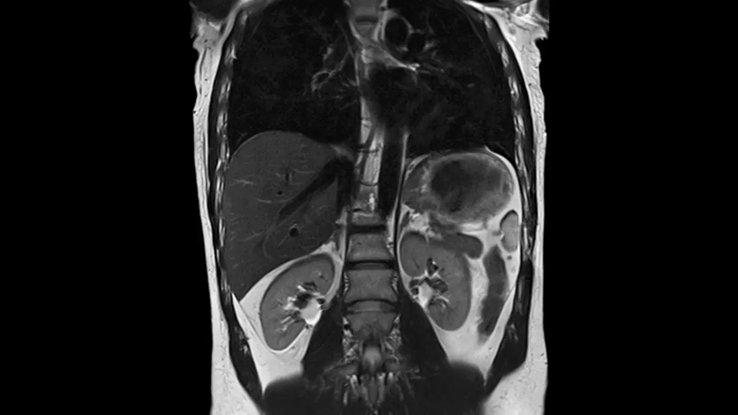 Coronal MRI scan of abdomen showing kidneys and surrounding abdominal organs
