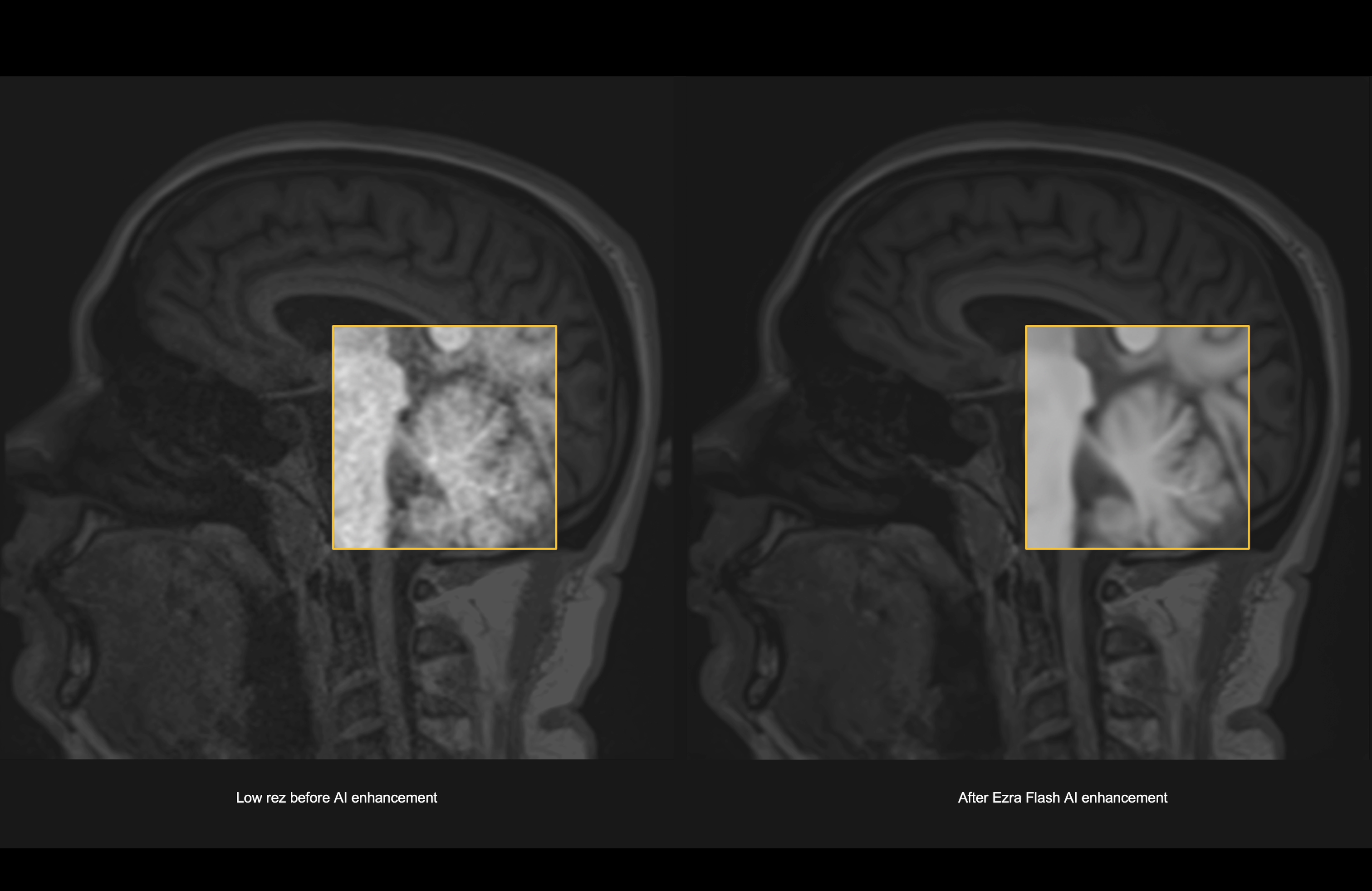 Before and after brain MRI scans demonstrating Ezra Flash AI image enhancement improvement