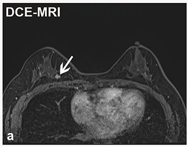 DCE-MRI scan of breast tissue with white arrow pointing to area of interest