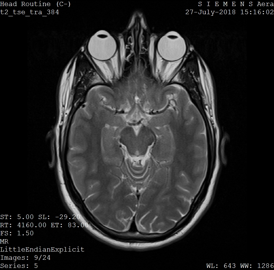 MRI brain scan showing axial view of brain and eye orbits