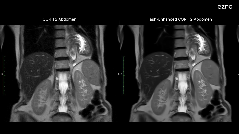 Side by side image of regular MRI scan and Ezra's flash enhanced MRI scan of the abdomen