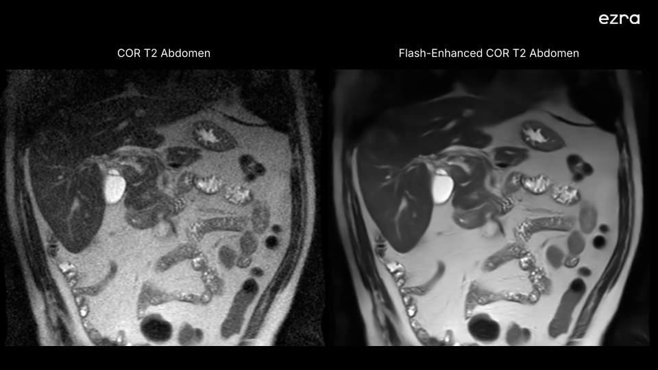 Different agnel of a side by side image of regular MRI scan and Ezra's flash enhanced MRI scan of the abdomen