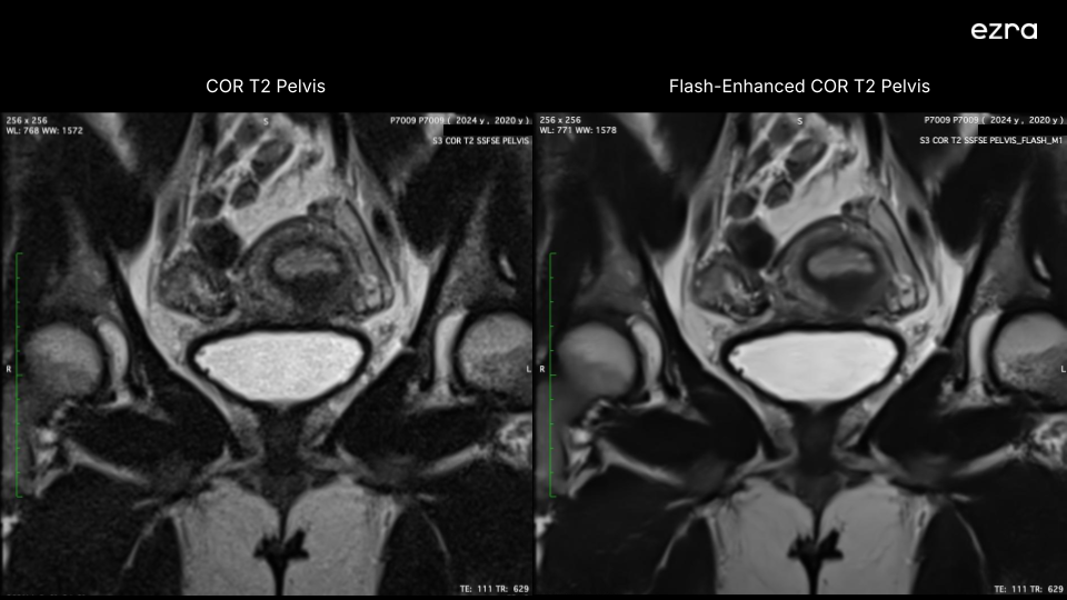 Side by side image of regular MRI scan and Ezra's flash enhanced MRI scan