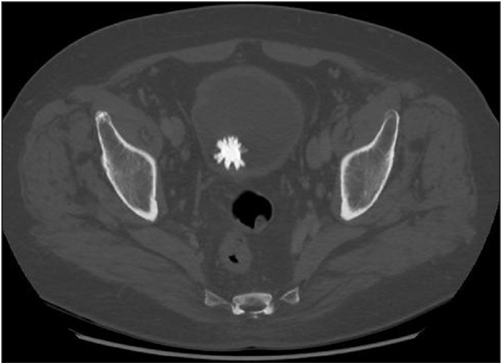 CT scan of a bladder stone adapted from https://www.researchgate.net/publication/324614002_Jackstone_Calculus_A_Spiky_Cause_of_Haematuria