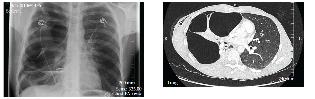 Chest X-ray and CT scan images of lungs showing pacemaker leads and axial cross-section view