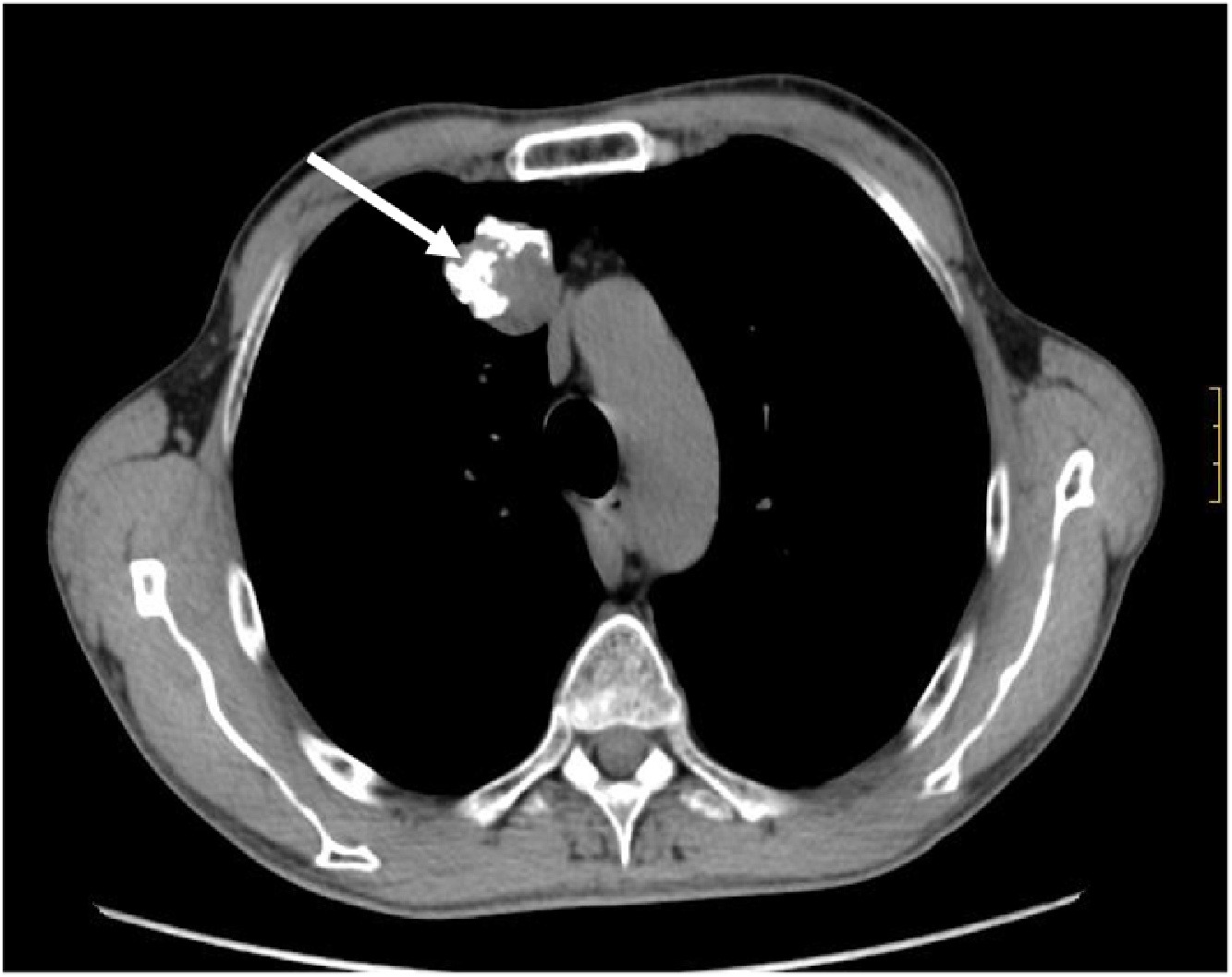 CT scan of chest showing cross-sectional view with arrow pointing to area of interest