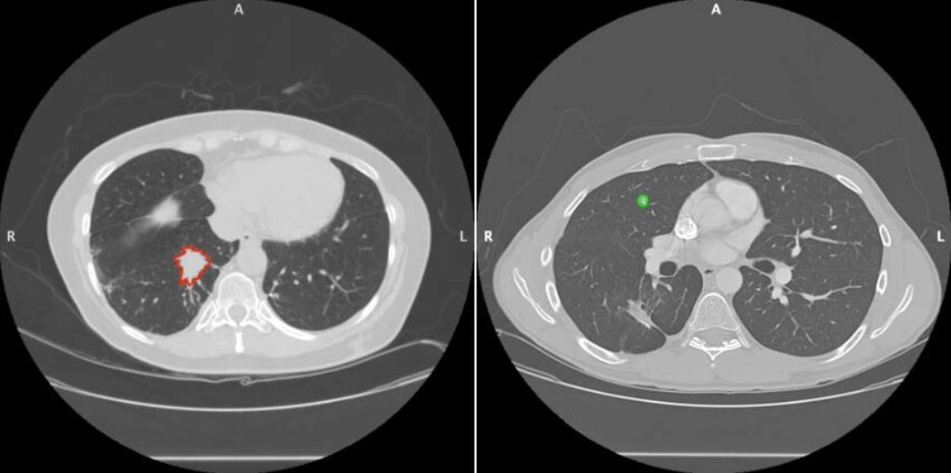 Two CT chest scans showing lungs with red highlighted area on left image and green marker on right image