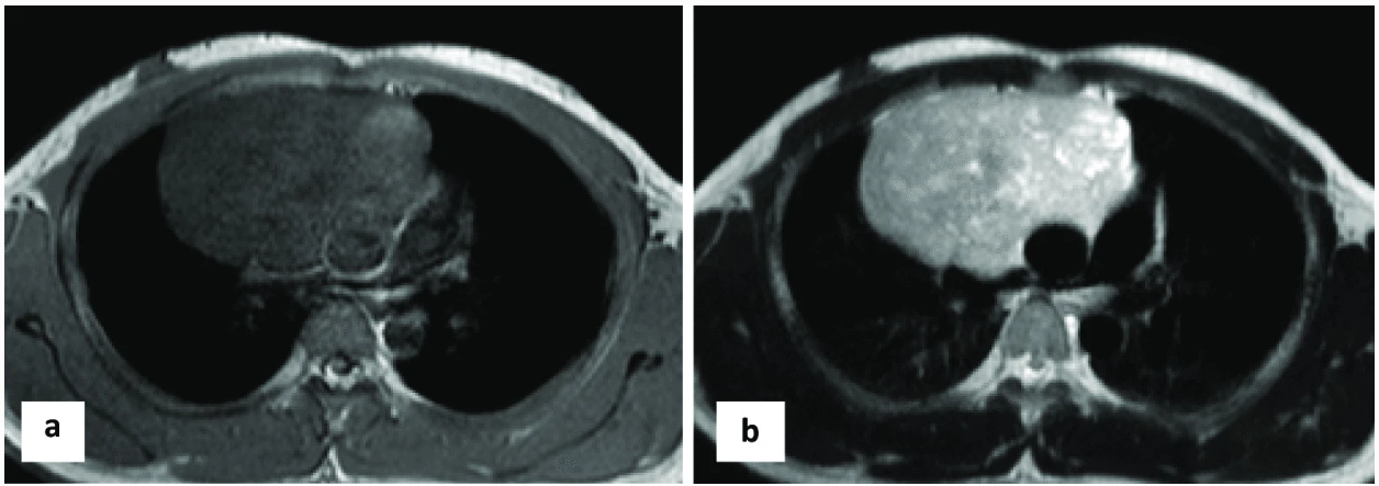 MRI scans of a 20-year-old patient with non-Hodgkin lymphoma.