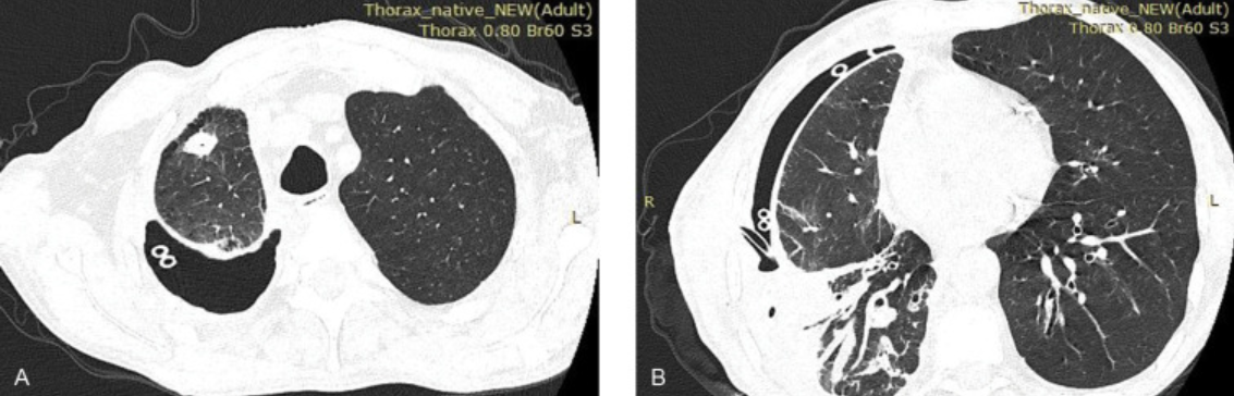 Two CT scan images of adult thorax showing cross-sectional views of lungs and chest cavity at different levels