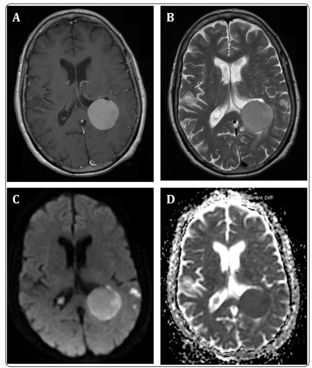 A gadolinium-enhanced MRI scan of the brain.