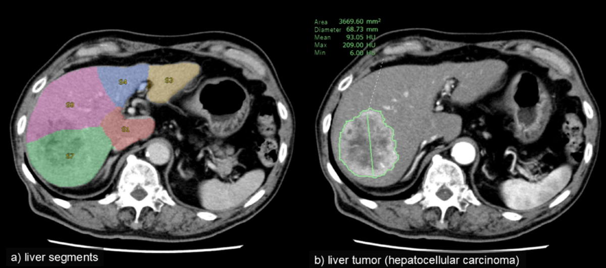 A Year in Liver Cancer Research: Key Advances in 2025