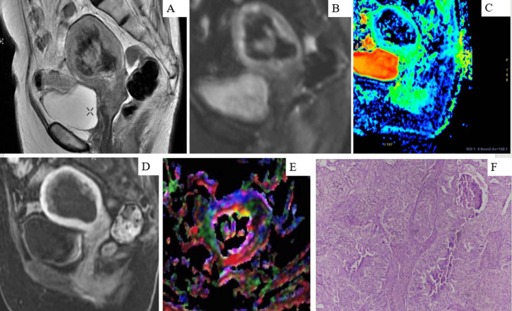 An MRI showing an endometrial carcinoma through a number of different sequences.