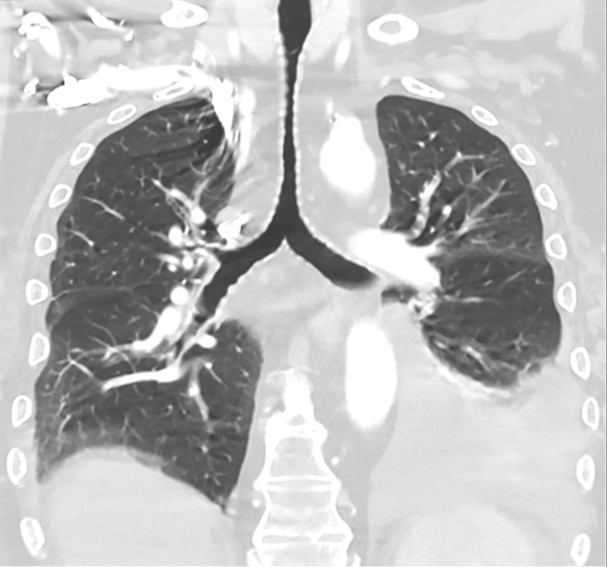 How Low-Dose CT Scans Help Detect COPD and Lung Damage Early