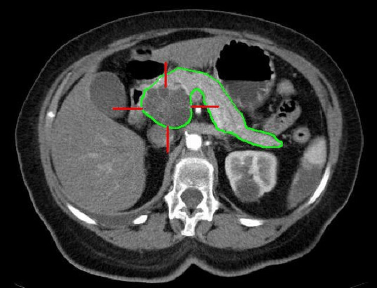 IPMN, the Benign Pancreatic Cyst: What You Need To Know