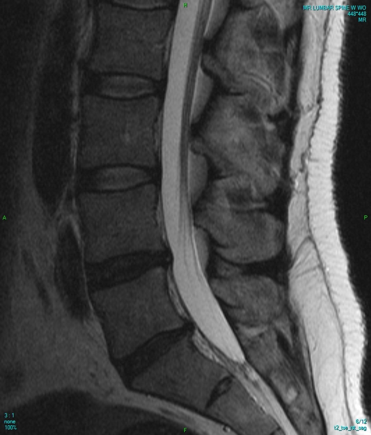 Can MRI Be Used to Detect Osteoporosis