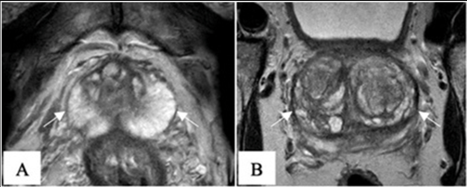 From Diagnosis to Treatment: Understanding Modern Prostate Cancer Options