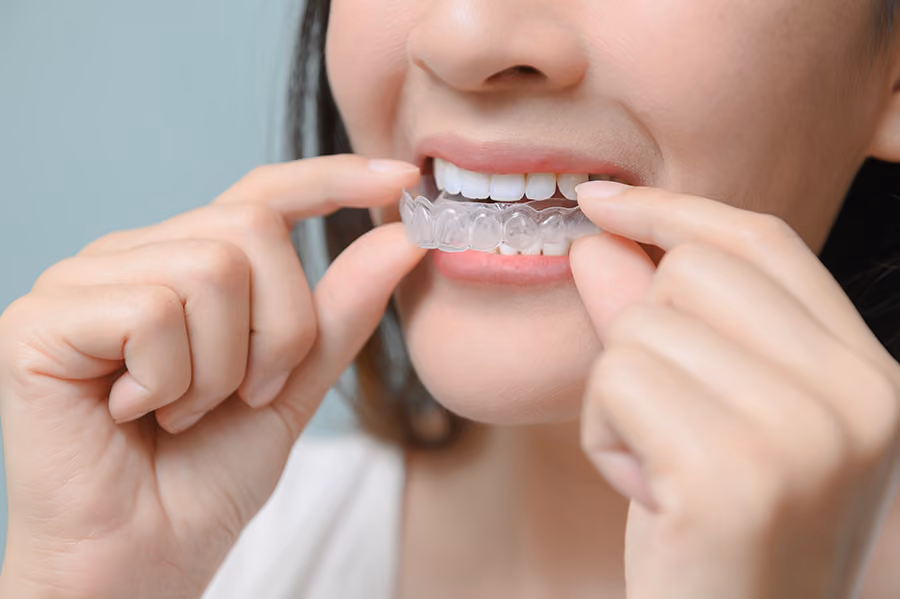 Close-up of a woman inserting a clear dental aligner onto her upper teeth.
