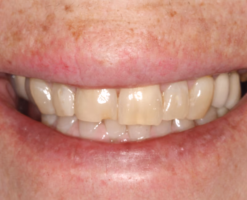 Close-up of a smile showing a front tooth with a small chip on the bottom edge.