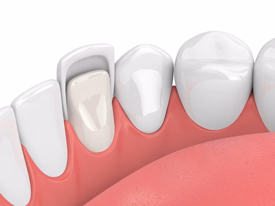 Veneers