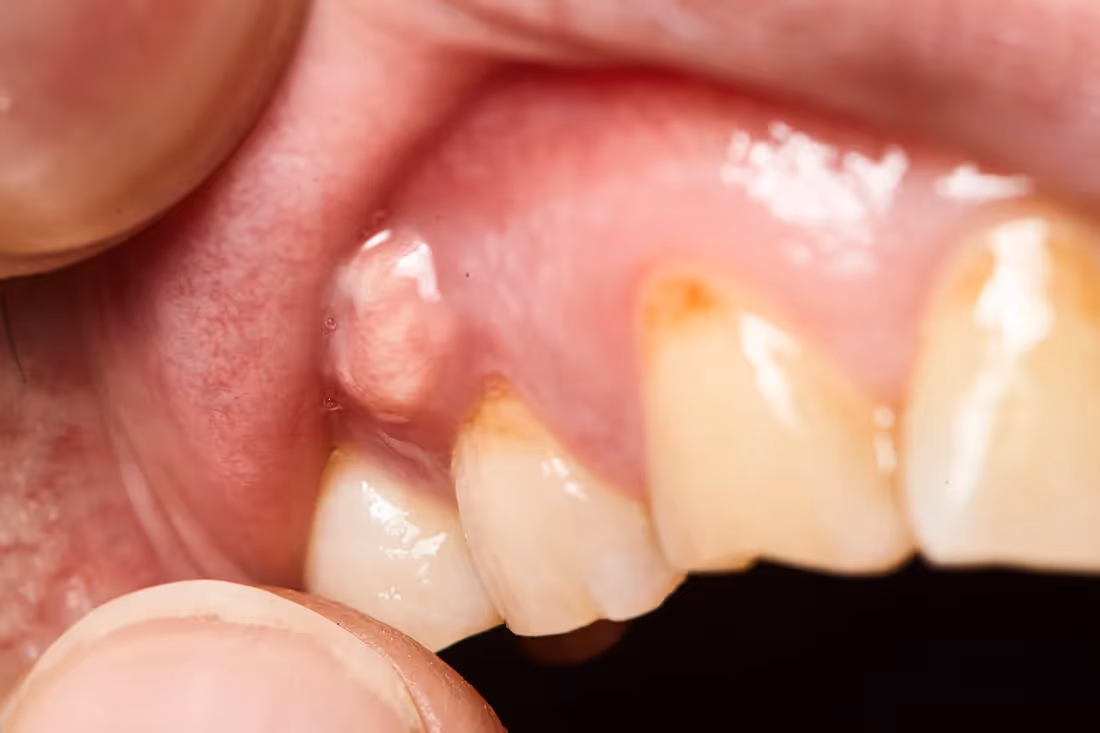 Abscess Treatment