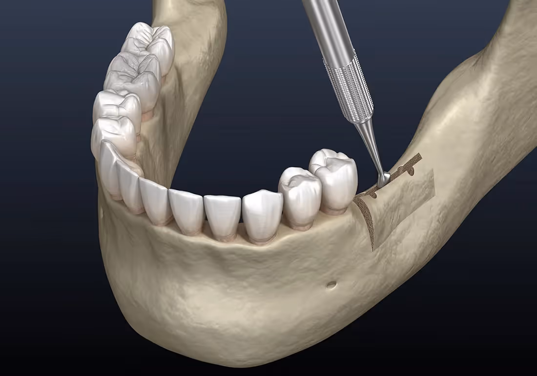 Ridge Augmentation