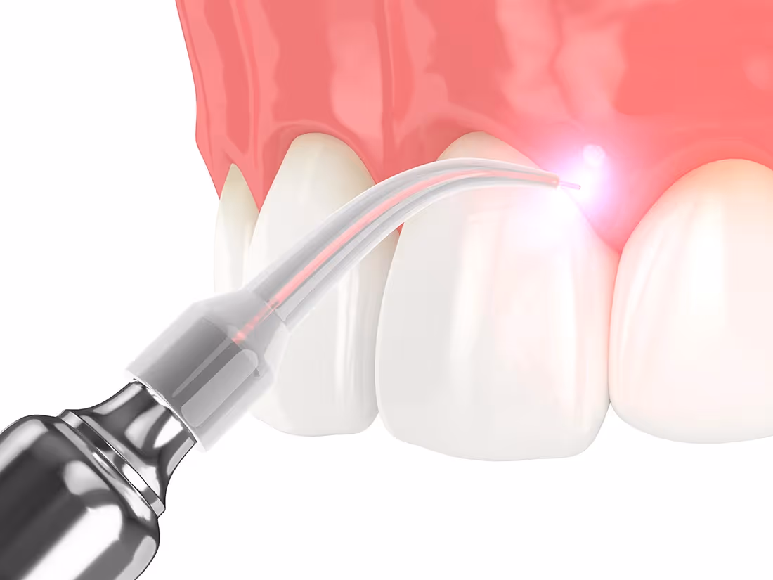 Soft-Tissue Laser Therapy