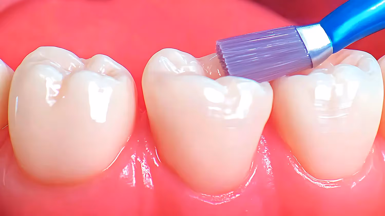 Dental Sealants