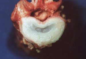 Dysk, krążek międzykręgowy