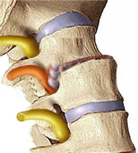 Dysk, krążek międzykręgowy