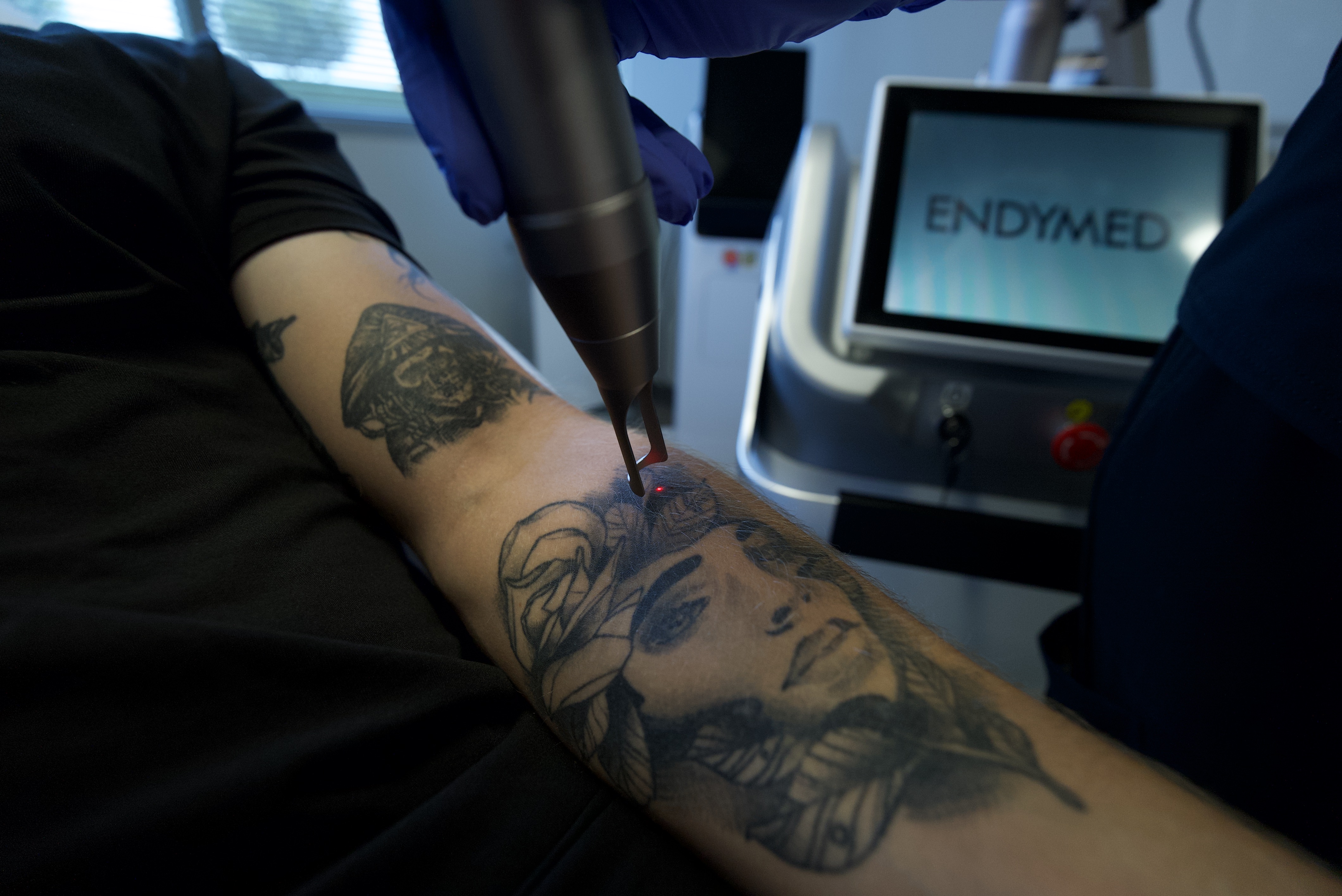 Tattoo Reduction