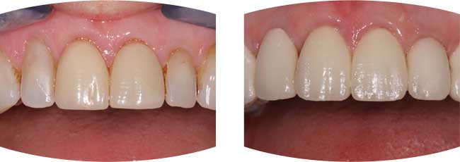 Before and after photographs of Air Flow stain removal treatment