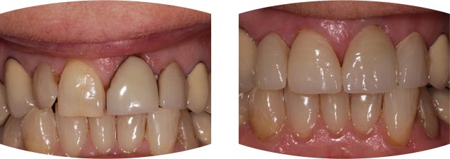 Ivoclar Vivadent Emax Porcelain Veneers