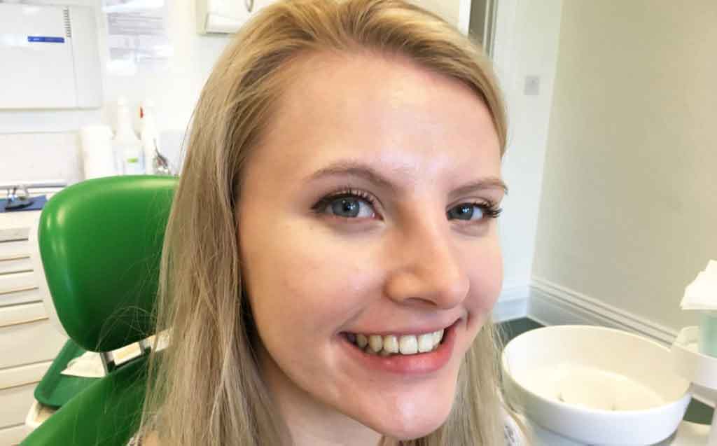 patient-smiling-after-invisalign-clear-braces