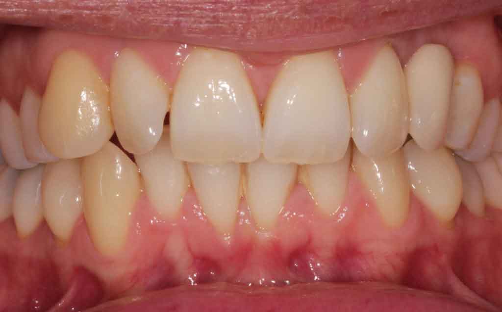 before-invisalign-treatment-image