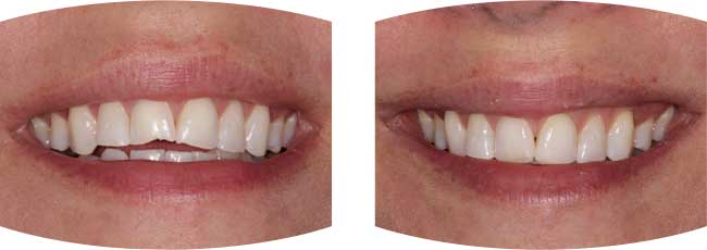 Before and after dental treatment photos of dental composite tooth repair.